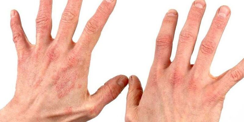 psoriasis a kezeken hogyan kell kezelni a népi jogorvoslati