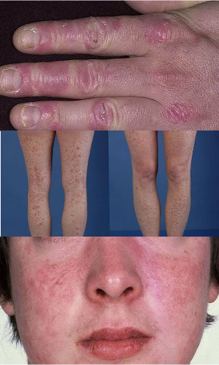 hogyan lehet gyógyítani a szőrös pikkelysömör nagy vörös foltok viszketés kezelés fotó
