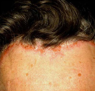 pikkelysömör a fejbőr kezelése népi gyógymódokkal vélemények vörös vérző folt a bőrön
