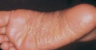 palmar pikkelysömör kezelése népi gyógymódokkal vörös foltok az arcon a szőrtelenítés után