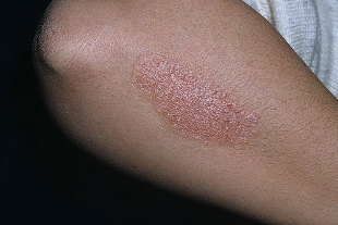 arthropathic psoriasis kezelése népi gyógymódokkal vörös foltok a bőrön vérbetegségekkel